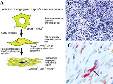 Initiation Of Angiogenic Kaposis Sarcoma Lesions Cancer Cell