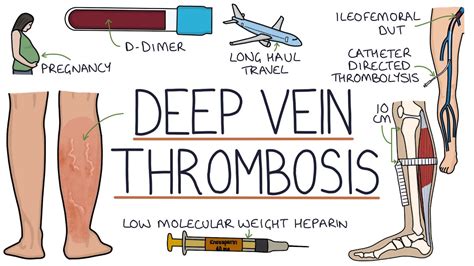 Deep Vein Thrombosis – Causes, Symptoms And Treatment