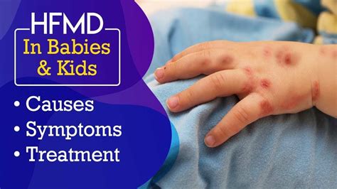 Hand Foot And Mouth Disease HFMD In Babies Causes Signs And