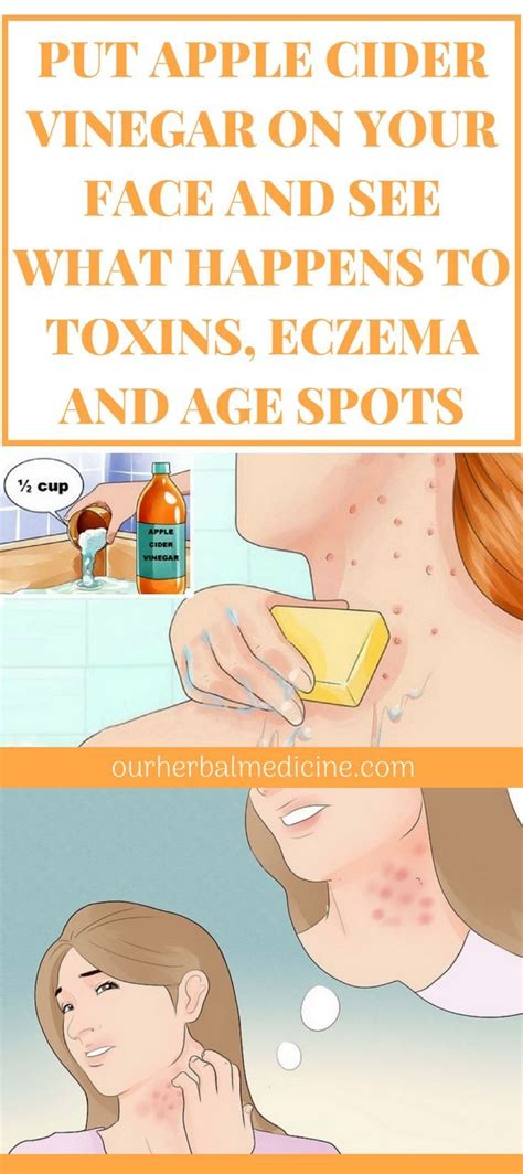 Put Apple Cider Vinegar On Your Face And See What Happens To Toxins Eczema And Age Spots