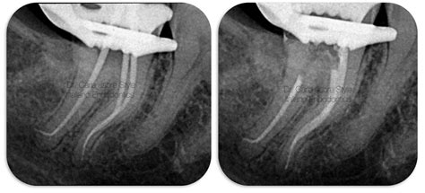 Management Of S Shaped Root Canals Style Italiano Endodontics