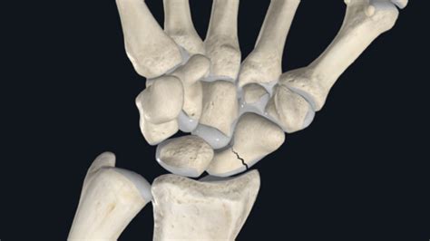 Scaphoid Fractures Orthopedia