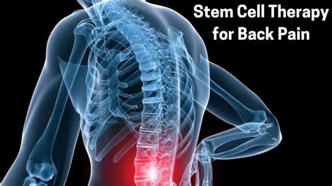 Stem Cell Therapy For Back Pain Myhealthgeek