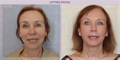 Resultados Lifting Facial Im Clinic