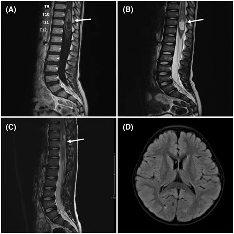 Mri Findings Of Spinal Ependymomazfta‐yap1 Fusion A Sagittal