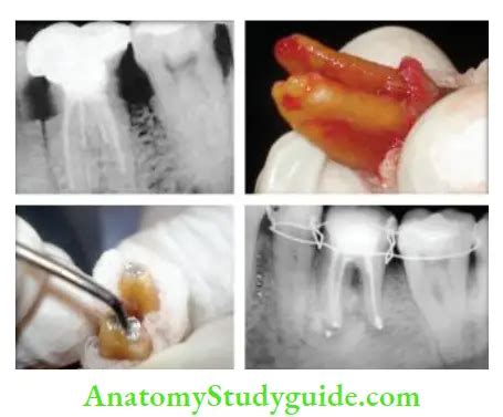 The Replantation And Transplantation Of Teeth Notes Anatomy Study Guide