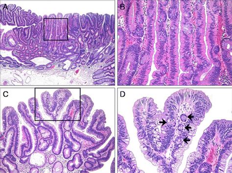 Conventional Adenoma Ca With A Focal Villous Architecture A