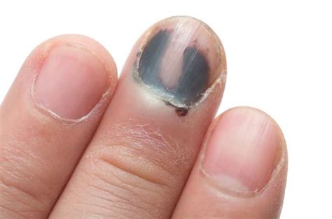 Health Warnings Your Fingernails May Be Sending