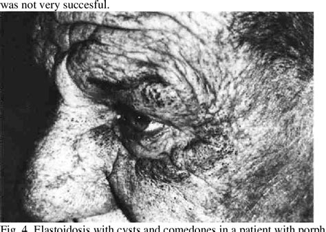 Figure From Porphyria Cutanea Tarda With Hepatic Involvement Nodular