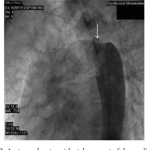 Figure 3 From Thoracic Stent Graft Implantation For Aortic Coarctation With Patent Ductus