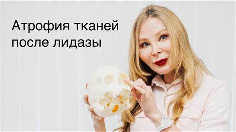 Результаты введения лидазы после филлеров - YouTube