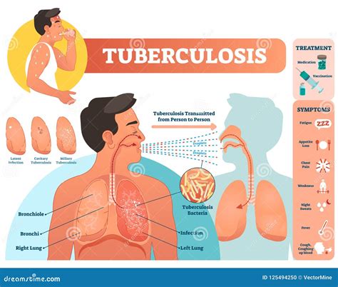 Tuberculosis Vector Illustration Detailed Symptoms And Treatment