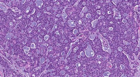 Adenoid cystic carcinoma | Ottawa Atlas of Pathology