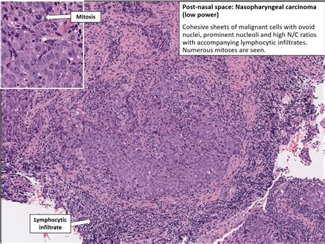 Head Nasopharyngeal Carcinoma Nus Pathweb Nus Pathweb