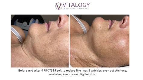 PRX T33 Peel Non Peeling Peel Safe For All Skin Tones