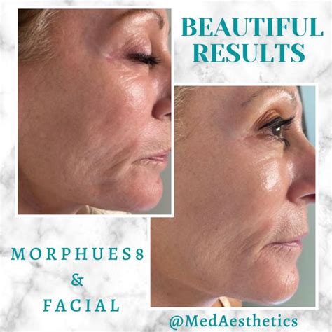 Tighter Skin Brevard Medical Spa Aesthetician Med Spa Facial Care