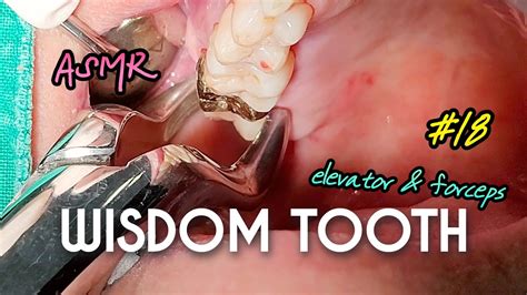 ASMR Wisdom Tooth Extraction In 1 Minute 4k YouTube