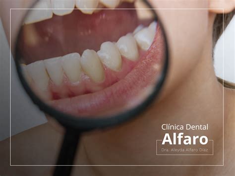 Curetaje Cl Nica Dental Alfaro