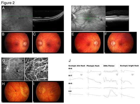 Spectral Domain Optic Coherence Tomography Sd Oct Of The Left Eye