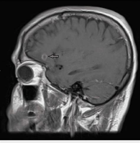 Sagittal T Weighted Magnetic Resonance Imaging Of The Initial Cm