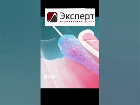 Лазерная вапоризация геморроя операция. Анимация как делается. - YouTube