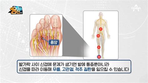 지긋지긋한 전신 관절 통증~♨ 발가락 사이로 잡는다 나는 몸신이다 323 회 Youtube