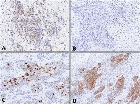 A Immunohistochemical Staining For Cd Showed Positivity For Tumor