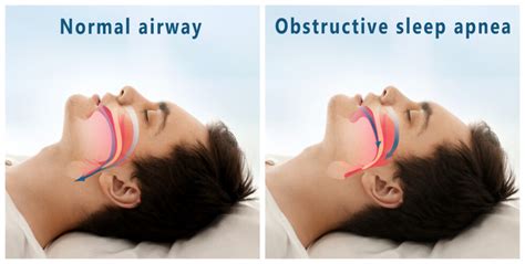 Airway Explained Ecologic Dentistry The Natural Choice