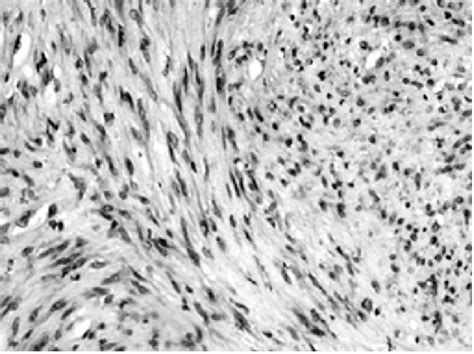 Spindle Cells Are Arranged Haphazardly In Short Fascicles H E