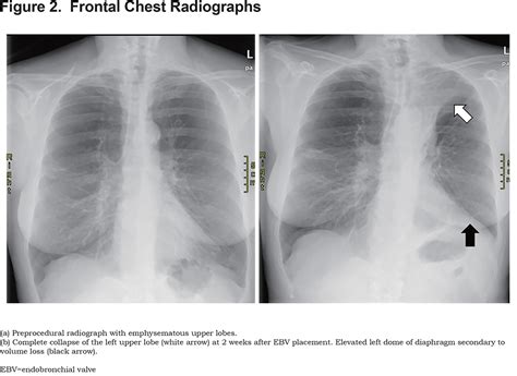 Bronchoscopic Lung Volume Reduction Using Endobronchial Valves: Imaging Appearance > Journal of ...