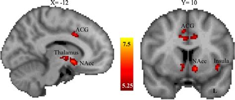 Brain Regions Showing Significant Activation For Incentive Versus