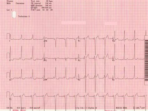 Wolff Parkinson White Syndrome Causes Symptoms Treatment