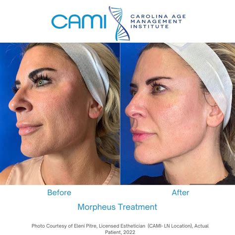 Best Skin Tightening Treatment For Face And Neck Cami Med Spa