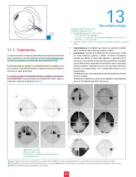 Trauma Y Neurooftalmo 2 13 Neuroftalmología 13 camPimEtría Las