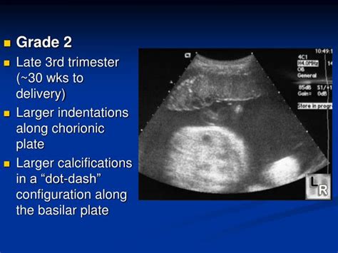 Ppt Placental Us Powerpoint Presentation Id3356735