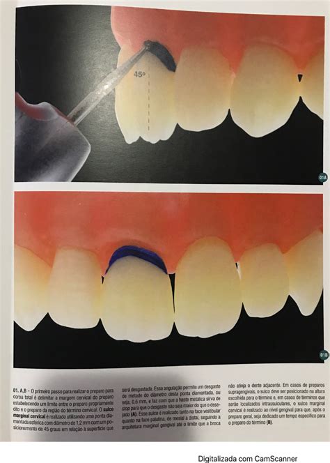 Preparo e cimentação de coroas unitárias Dentística