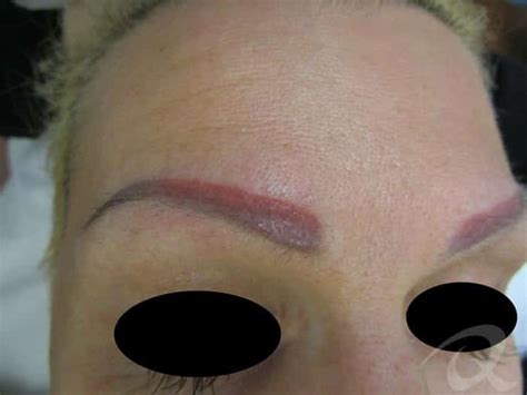 Before after pictures and photos of permanent makeup removal