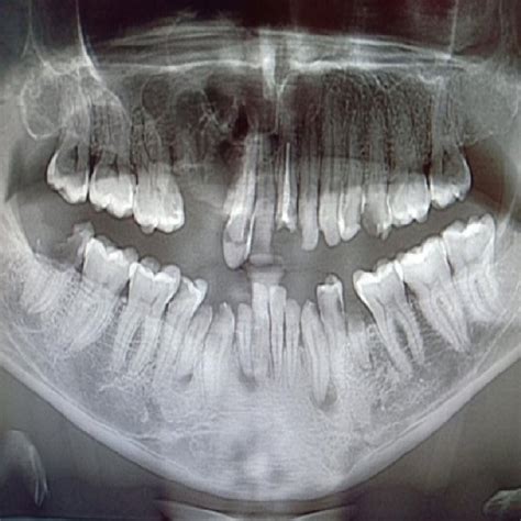 Pdf Hybrid Ameloblastoma Of The Maxilla A Case Report And Review Of