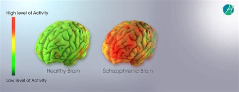 Schizoaffective Disorder: Symptoms and Treatment | Psychiatry | HealthSoul