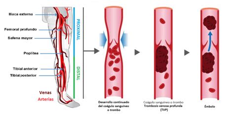 Como Prevenir La Trombosis Venosa El Men