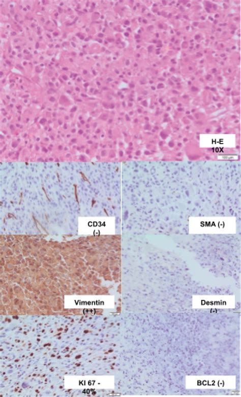 Primary Radiation Induced Sarcoma Of The Penis Case Report And Review