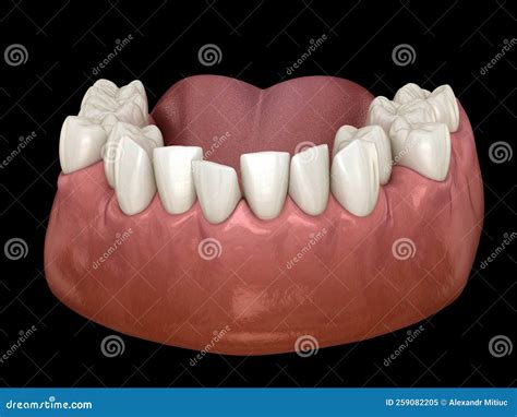 Overcrowded Teeth Abnormal Dental Occlusion Medically Accurate Tooth