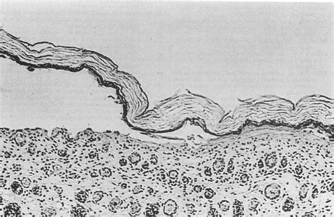 Figure 1 From Staphylococcal Scalded Skin Syndrome Semantic Scholar