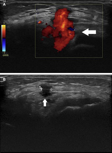 Synovial Hemangioma Of Infrapatellar Hoffa Fat Pad Magnetic