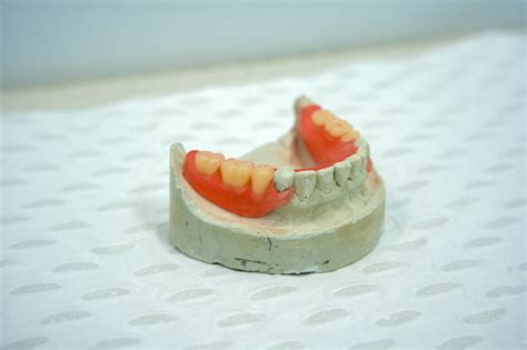 Partial Dentures For Back Teeth Advance Oral Dentures