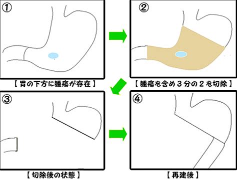 腹腔鏡下幽門側胃切除術｜医療法人慶仁会 城山病院