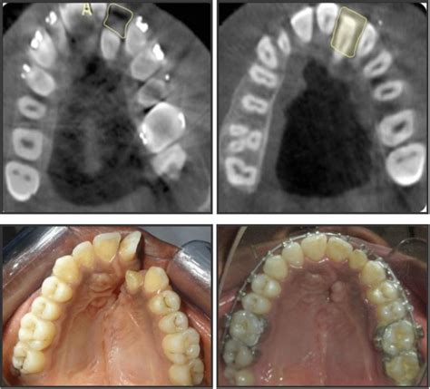 Evaluation Of Maxillary Alveolar Ridge Formation And Ridge Continuity