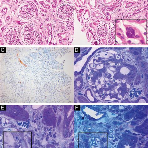 Medial vasculopathy in a case of Barakat syndrome. (A) (H and E, ×100):... | Download Scientific ...