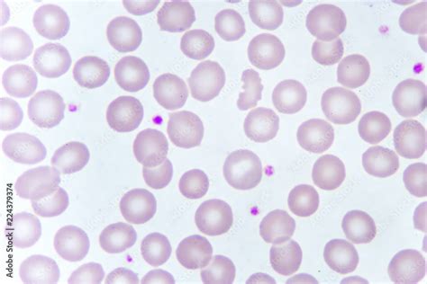 Red Blood Cells And Platelet In Blood Smear Analyze By Microscope