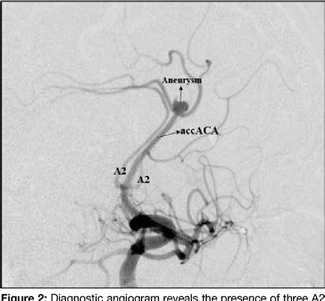 Ruptured Distal Accessory Anterior Cerebral Artery Aneurysm A Case Report And Literature Review